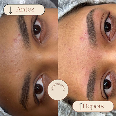 Antes/Depois da Micropigmentação Essence Brow