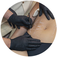 Bioestimuladores de Colágeno Corporais